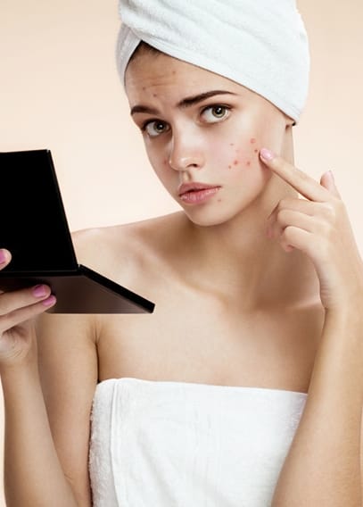 Acne Treatment San Diego, CA