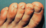 Nail Fungal Infections Treatment