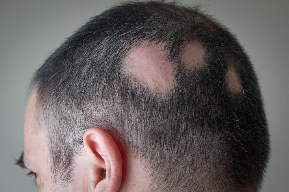Man with bald spots from alopecia