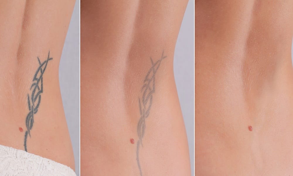Comparing Tattoo Removal Cream with Laser Removal
