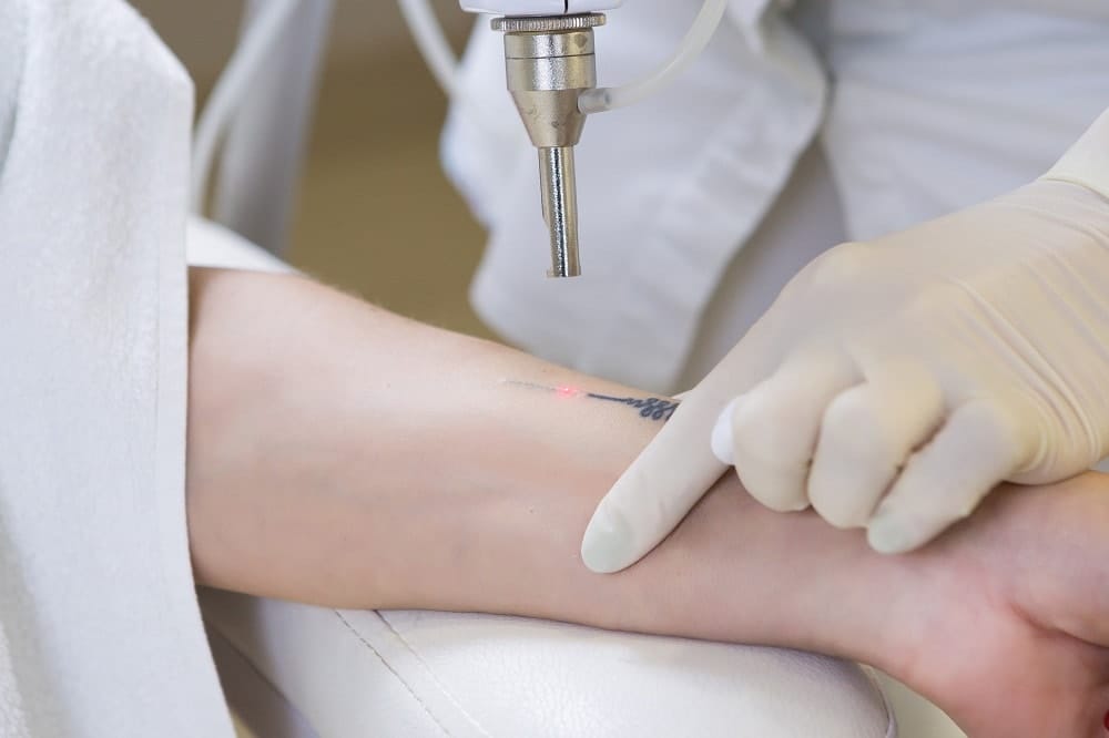 Does tattoo removal cream work?