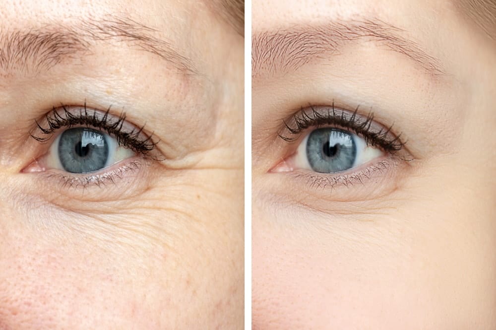Before and after Botox injection at dermatology center in San Diego, CA