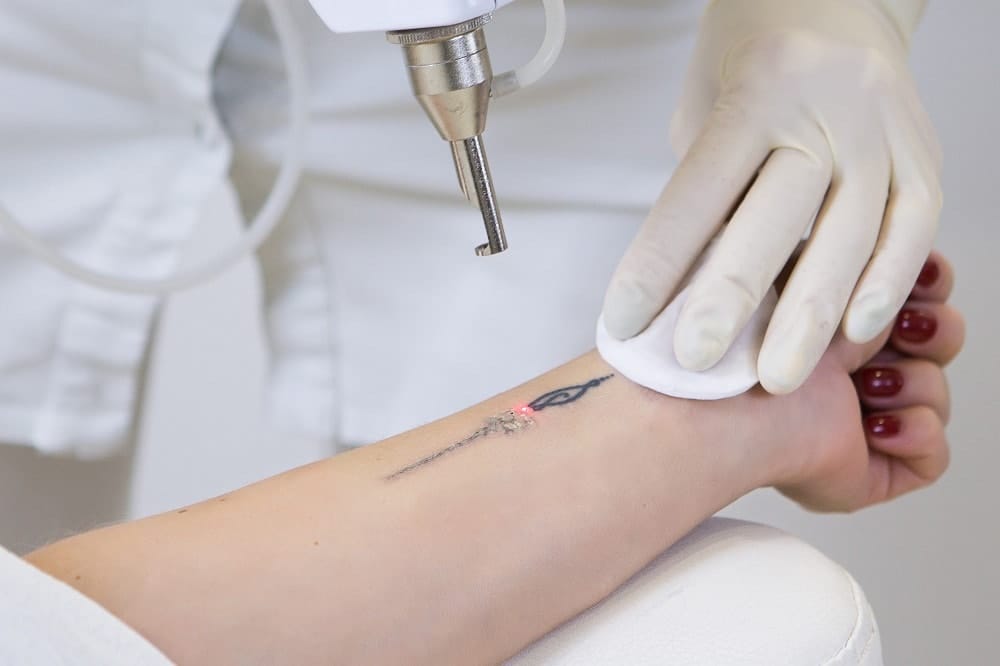 Is the Best Time for Tattoo Removal in the Winter?