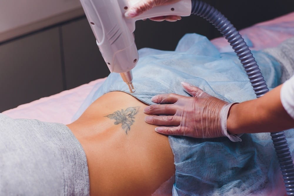 Things to Consider When Choosing a Laser Tattoo Removal Clinic