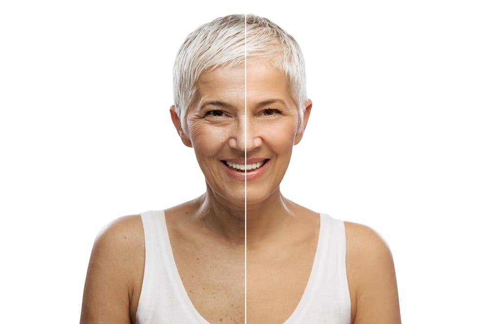 Before and After of Older Woman with Botox