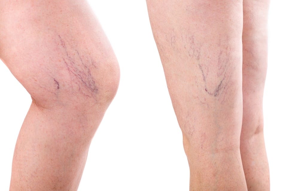 Laser Treatment for Spider Veins: Before and After Photos, Recovery
