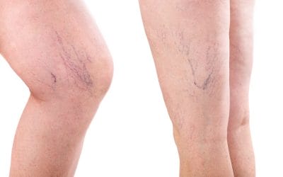 Things to Expect When Having a Spider Vein Removal Procedure