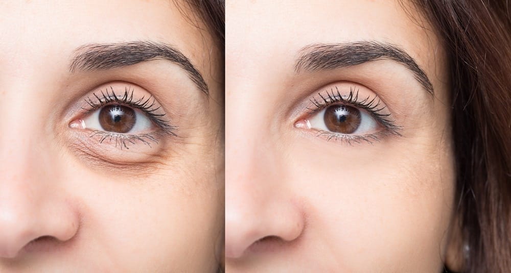 How Restylane Can Fix Your Undereye Bags