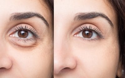 How Restylane Can Fix Your Undereye Bags